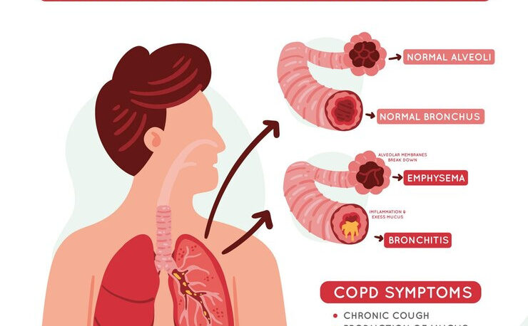 COPD Symptoms In Houston