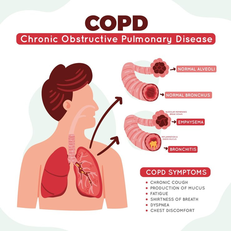 COPD Symptoms In Houston