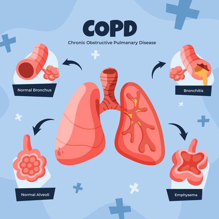 COPD treatment in Houston